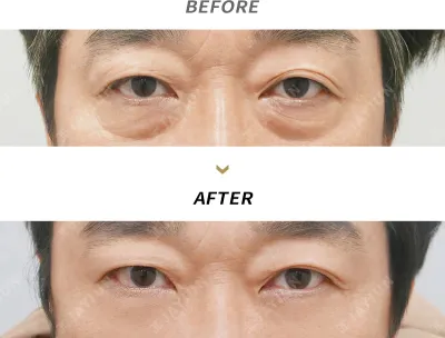Before & After