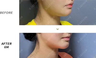 Before & After