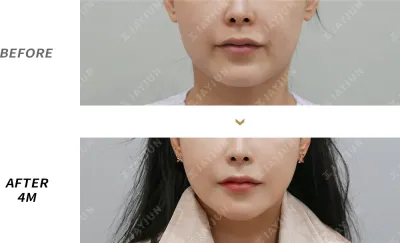 Before & After