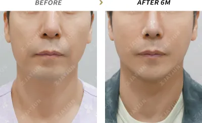 Before & After