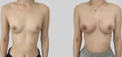 Before & After