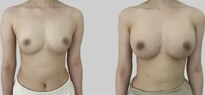 Before & After