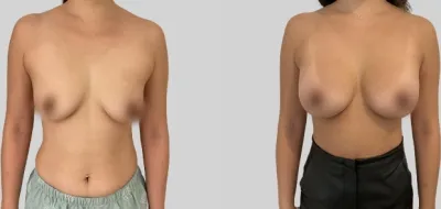 Before & After