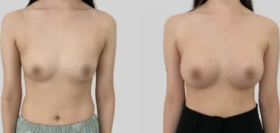 Before & After