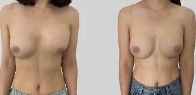 Before & After