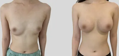 Before & After