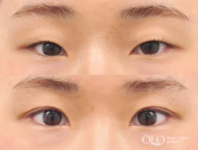 Before & After
