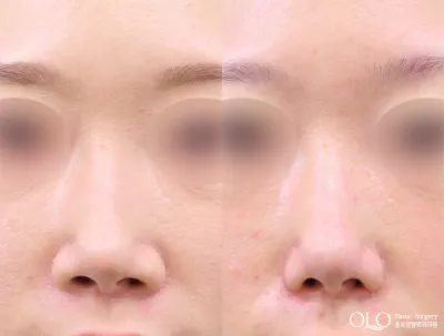 Before & After