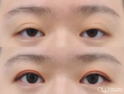 Before & After