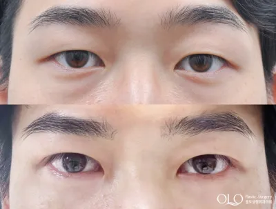 Before & After