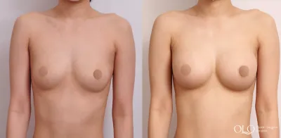 Before & After