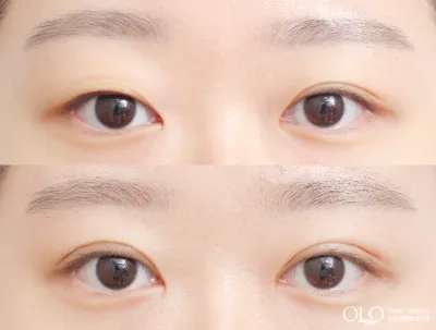 Before & After