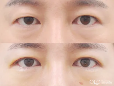 Before & After