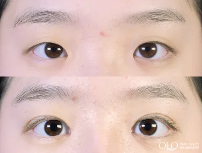 Before & After
