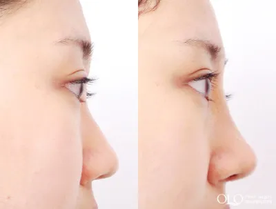 Before & After