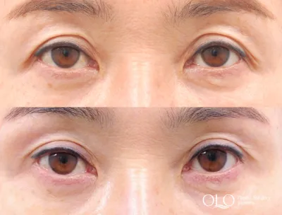 Before & After