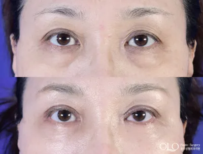 Before & After