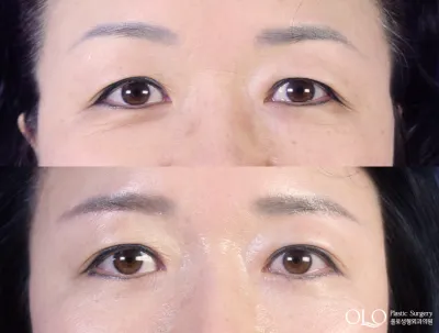 Before & After