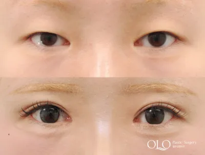 Before & After