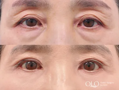 Before & After