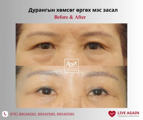 Дурангын хөмсөг өргөх мэс засал "  " Apex " Гоо сайхны мэс заслын эмнэлэг  Before & After 
