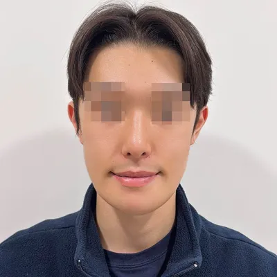 Mình đã thực hiện phẫu thuật gọt mặt và nâng mũi cùng lúc!