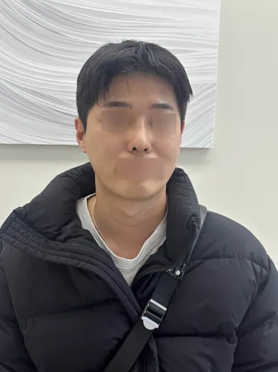 Review phẫu thuật lại mũi nam của mình!!