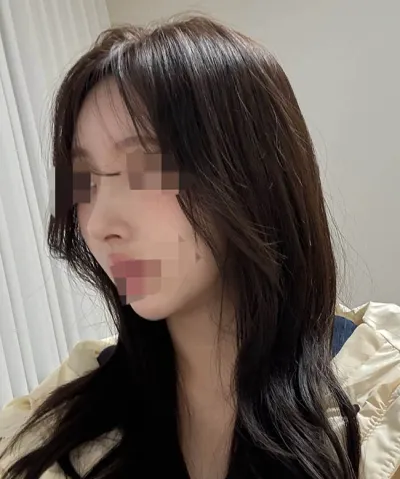 Mình cực kỳ hài lòng với phẫu thuật nâng mũi bằng sụn sườn tự thân luôn >< ㅎㅎ