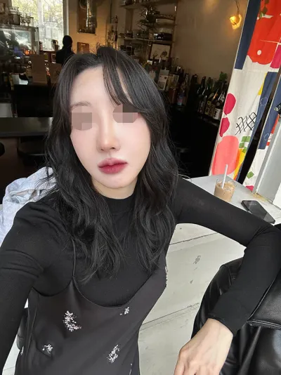 Review của mình về phẫu thuật nâng mũi lại (sụn sườn tự thân) từ Viện trưởng Kim Hyun-woo.