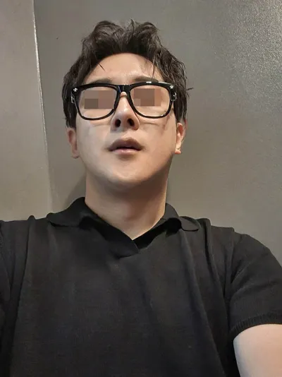 Nam / Mình đã thực hiện nâng mũi, gọt mặt và khâu cơ cổ cùng lúc.