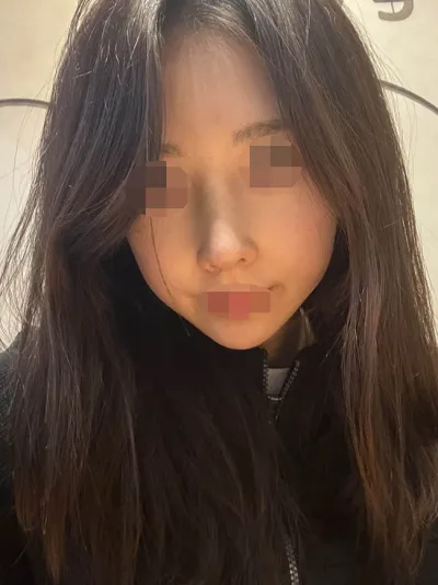 Mình đã phẫu thuật nâng mũi bằng sụn sườn tự thân tại Want!