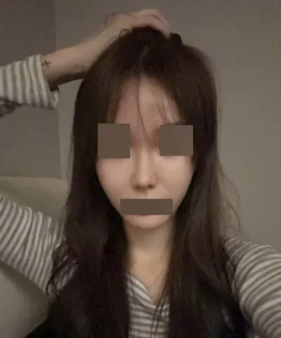 Mình đã phẫu thuật mũi lần thứ hai thành công tại Want ^^