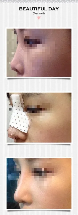 Ngày thứ 10 sau khi mình phẫu thuật mũi!!