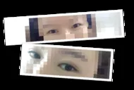 Đó là lần phẫu thuật lại của mình mà,,,