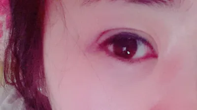 Sau 10 năm nhấn mí thì bị bung hết cả ra...ㅠㅠ