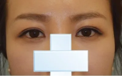 Lo lắng vì mí cứ bị tuột nên...