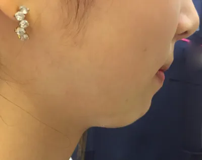 Mình bị móm nặng nên ban đầu cũng nghĩ đến phẫu thuật chỉnh hình cằm