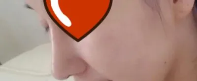 Sau khi thi đại học xong, mình đã đi nâng mũi cùng bạn nè