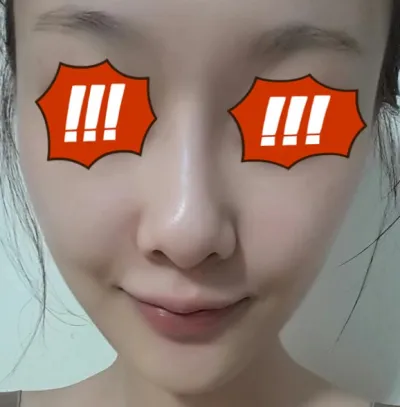 Mình là Sun , mình là người đã cấy mỡ mặt khoảng một tháng trước đây. Mọi người vẫn khỏe chứ ạ?