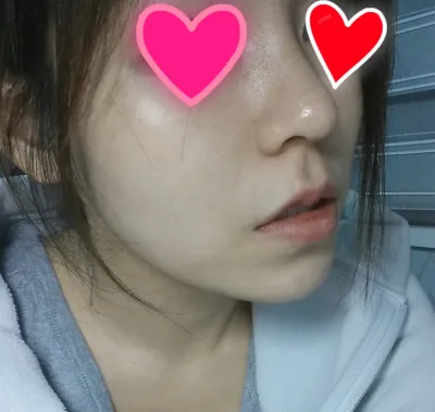 Xin chào, mình làm mũi được hơn 1 tuần rồi, dáng mũi tự nhiên quá nên mình khoe với mọi người nè ^^