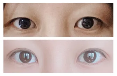 Review 3 tháng sau cắt mí