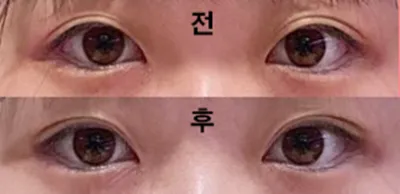 Mình làm mắt hai mí kiểu nhấn mí ạ!