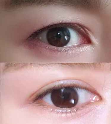 Cắt mí mắt (phương pháp rạch) ưng ý lắm nha!