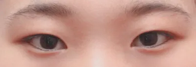 Cắt mí và mở góc mắt trước được 1 tháng rồi nè