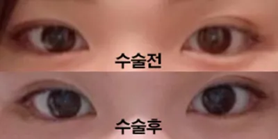 Tái phẫu thuật mắt hai mí được 3 tháng rồi ạ!