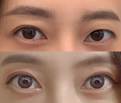 Review sau 6 tháng tái phẫu thuật