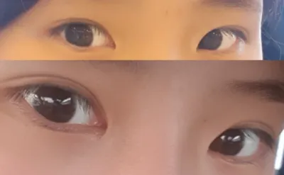 Review 2 tháng sau cắt mí trước và tái phẫu thuật mắt 2 mí ~