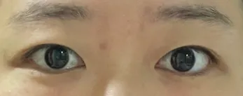 Review 5 tháng sau cắt mí và mở góc mắt trong