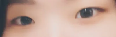 Review làm mắt 2 mí (kiểu nhấn mí) và mở góc mắt trước nè 🥰