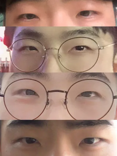 Review về cắt mí mắt (rạch) + mở góc mắt trước